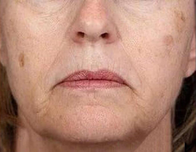 Вікові плями на обличчі - причини, лікування і домашні засоби