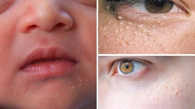 Білі прищики на обличчі - причини, фото і лікування