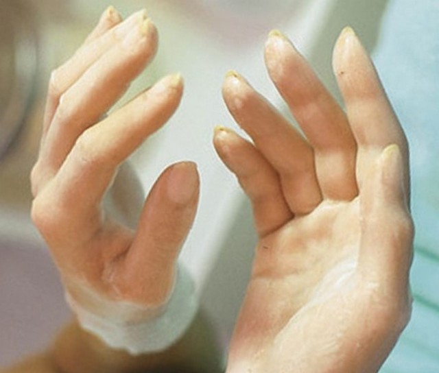 Тендітні, ламкі нігті - причини, лікування, домашні засоби