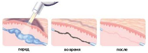 Видалення судинних зірочок на обличчі лазером: показання та протипоказання, відгуки, ціни, відновний період, побічні ефекти