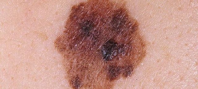 Види і причини темних плям на шкірі