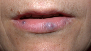 Шишка на внутрішній стороні губи - причини, лікування