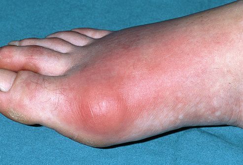 Розпух великий палець на нозі - причини, фото, лікування