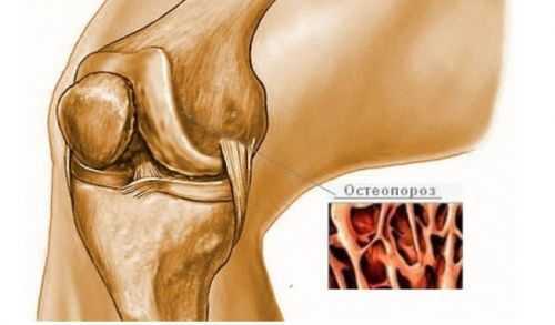 Хрумтять коліна при згинанні або розгинанні - причини і що робити