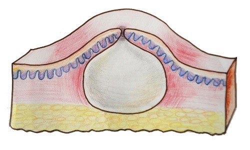 Горбки, шишки і ущільнення на внутрішній стороні стегна