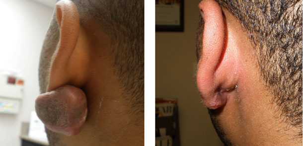 Шишка при пірсингу носа - причини, гранульома, келоїдних рубець