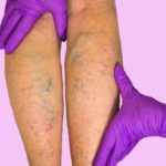 Варикоз на ногах у чоловіків: як лікувати, симптоми, чим небезпечний, профілактика, наслідки