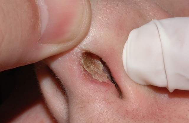 Рани в носі і навколо нього, які не загоюються - причини і лікування