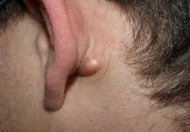 Шишка на потилиці, шиї або за вухом - фото, причини, лікування