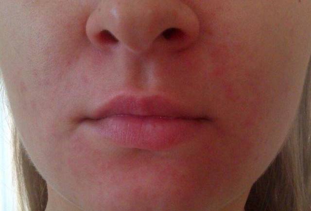 Суха шкіра навколо рота і носа - причини, фото, домашні засоби