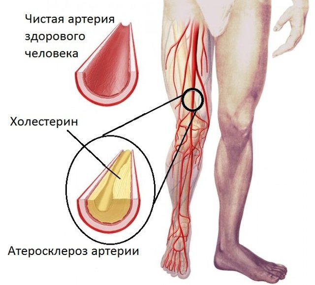 Узі судин і вен нижніх кінцівок: показання та протипоказання, підготовка, як проходить процедура, розшифровка результатів