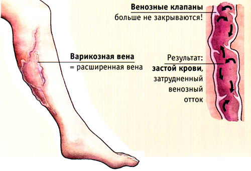Шишки, горбки на нижній частині ноги - фото, причини, лікування