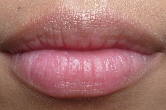 Чому опухла верхня губа - можливі причини, фото і лікування