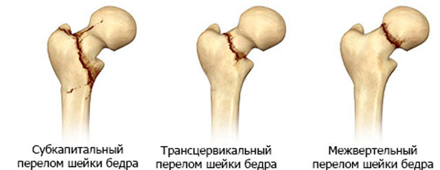 Біль на внутрішній стороні стегна - причини і лікування