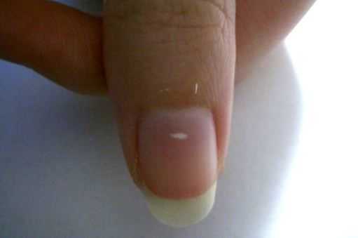 Білі плями на нігтях ніг - причини і лікування
