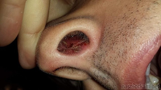 Рани в носі і навколо нього, які не загоюються - причини і лікування