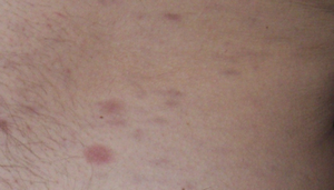 Висип або плями в області пахв - фото, причини, лікування
