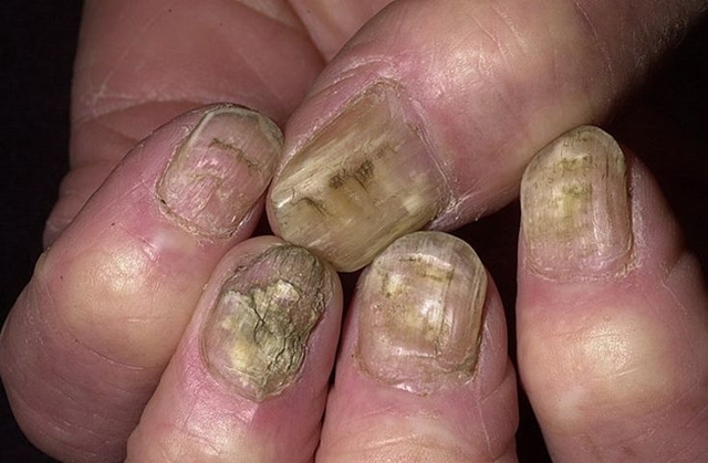 Темні плями або крапки на нігтях - причини, фото, лікування