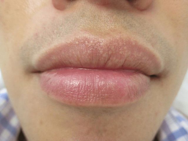 Білі плями на губах - види, причини, лікування