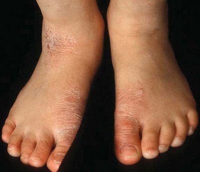 Болячки на ногах (виразки, пухирі) - фото, причини, домашні засоби