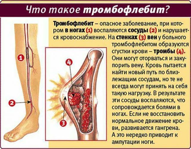 Варикоз на ногах у жінок: причини, симптоми, діагностика, стадії, лікування (медикаментозне, оперативне, народне), профілактика, ускладнення