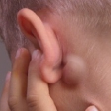 Шишка на потилиці, шиї або за вухом - фото, причини, лікування