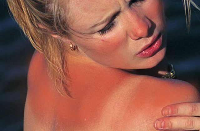 Губи обгоріли на сонці - лікування, полегшення симптомів і фото