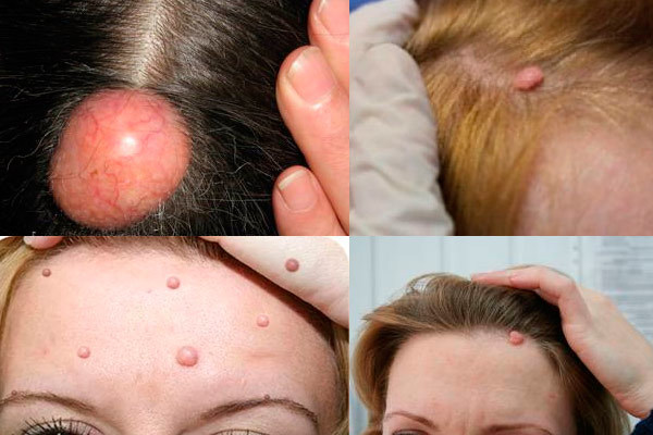 Шишка або кульку на голові під шкірою - причини, фото, лікування