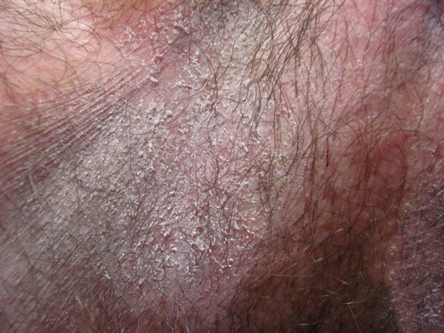 Суха шкіра, лущення на пенісі - причини і лікування