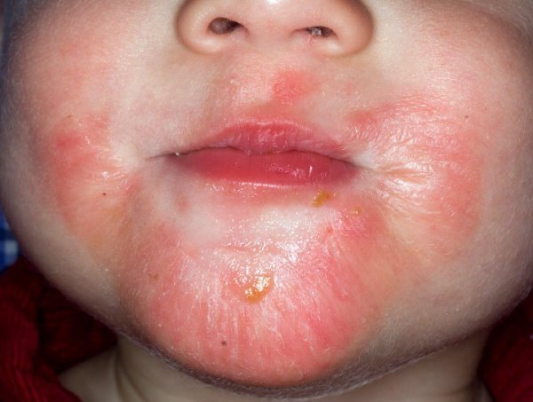 Суха шкіра навколо рота і носа - причини, фото, домашні засоби