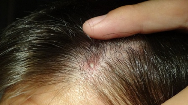 Шишка або кульку на голові під шкірою - причини, фото, лікування