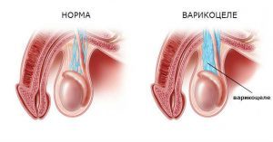 Секс після операції на варикоцеле: вплив на тривалість статевого акту, онанізм (мастурбація)