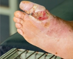 Болячки на ногах (виразки, пухирі) - фото, причини, домашні засоби