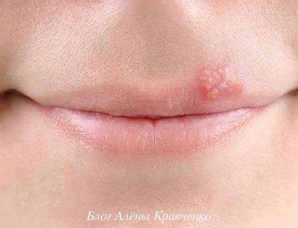 Червоні або білі болячки на губах - причини, фото, лікування