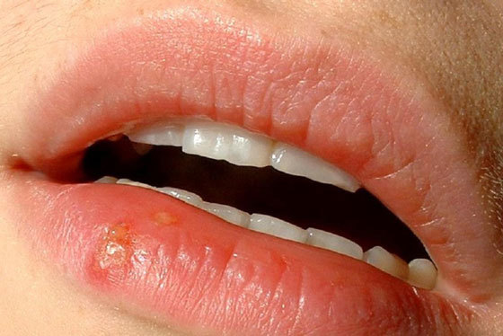 Екзема на губах - причини, симптоми, лікування