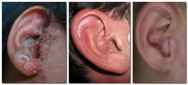 Сверблячка у вухах - причини і лікування в домашніх умовах