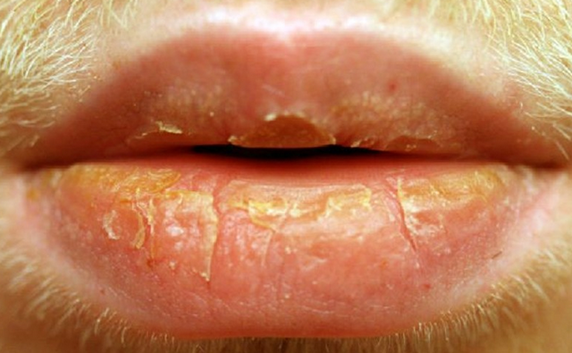 Грибок на губах у дорослого і дитини - причини, фото, лікування