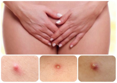 Шишки та прищі на статевих органах у жінок - причини і лікування