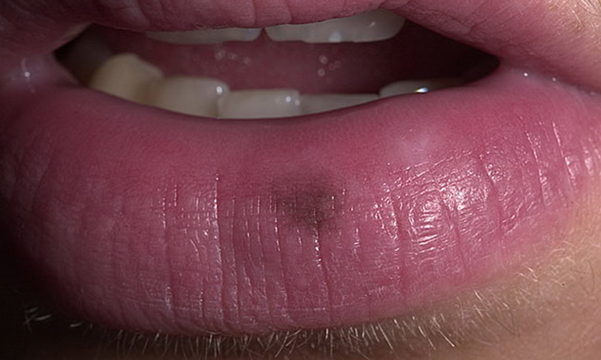 Чорні і темні плями на губах - фото, причини і як позбутися
