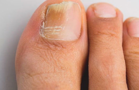 Темні плями або крапки на нігтях - причини, фото, лікування