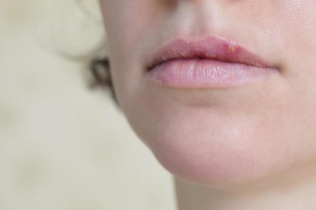 Прищі на губах і навколо них - причини, лікування