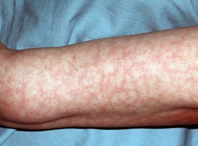 Мармурова шкіра - причини, види фото, лікування