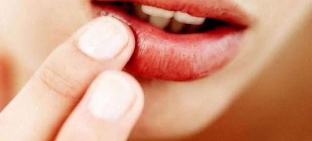 Слизова кіста на губі - симптоми, причини, лікування