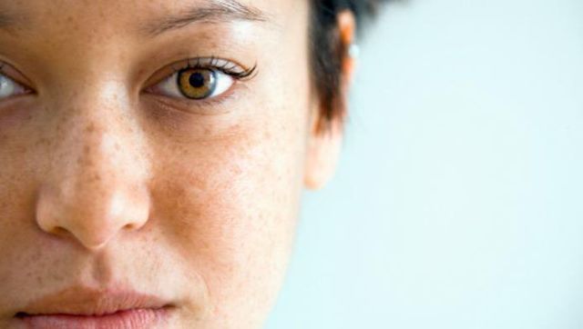 Темні плями на обличчі - причини і як позбутися