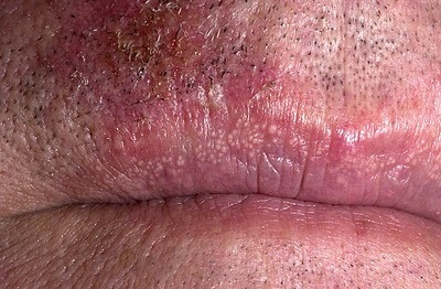 Білі плями на губах - види, причини, лікування