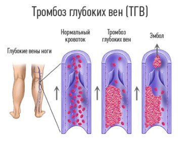 Тромбофлебіт глибоких вен нижніх кінцівок: причини, симптоми (хронічного, гострого), діагностика, лікування, профілактика (харчування), ускладнення