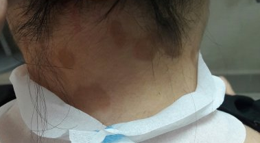 Темні плями на шиї, грудей і тулуб - причини, фото і як позбутися