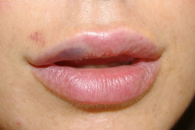 Чому опухла верхня губа - можливі причини, фото і лікування