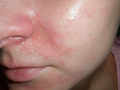 Суха шкіра, що лущиться навколо носа - причини і що робити