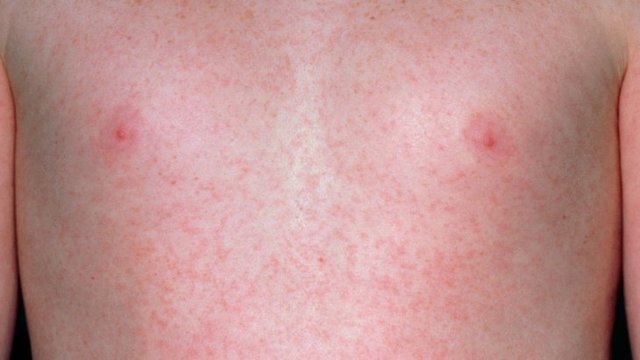 Червоні плями на шкірі - причини, фото і як позбутися